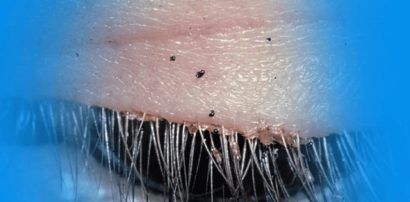 How to Get Rid of Lice in the Eyelashes